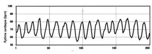 Cohérence cardiaque identifiable sur un graphique